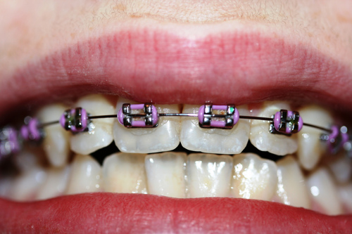Orthodontic braces may result in immunotolerance to nickel ACD.*